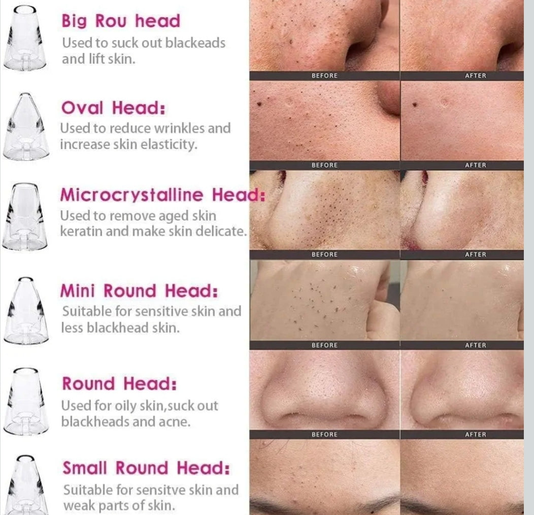 4 In 1 Multi-Function Blackhead and Whitehead Remover