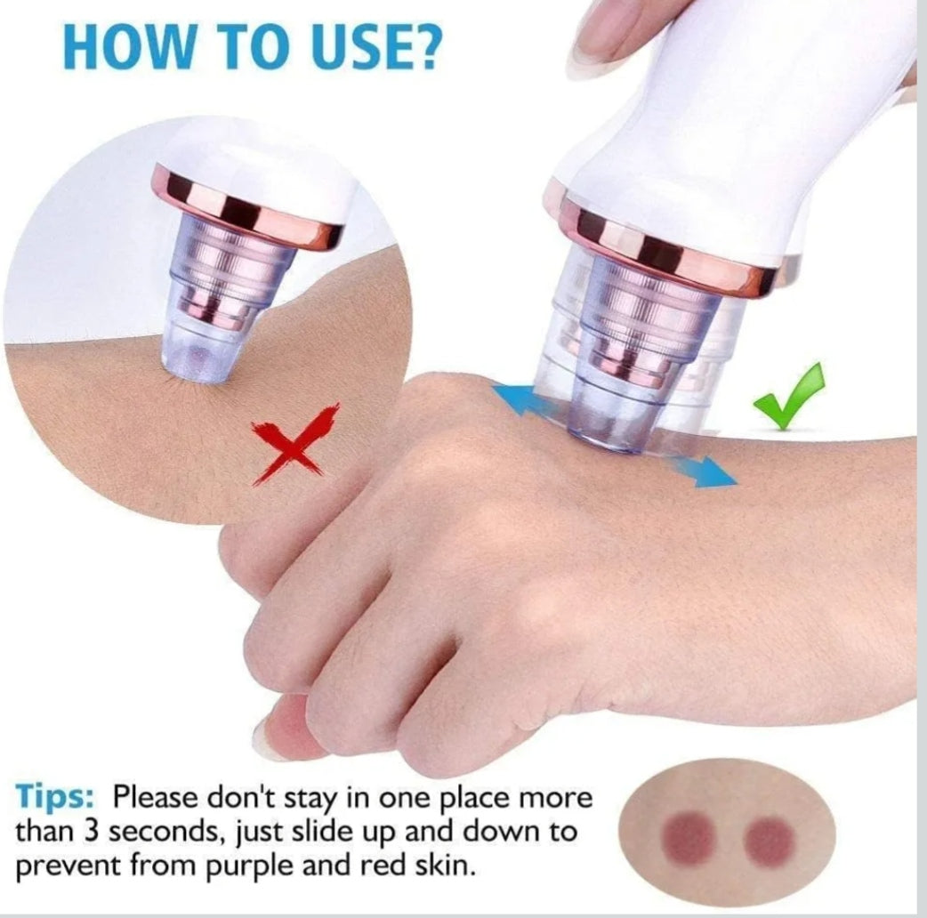4 In 1 Multi-Function Blackhead and Whitehead Remover
